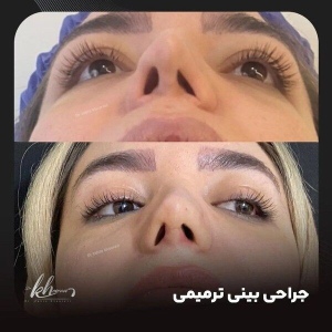 جراحی-بینی-15