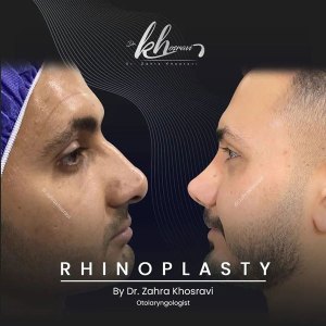 جراحی-بینی-2