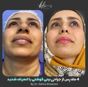 جراحی-بینی-30