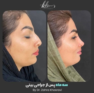 جراحی-بینی-31