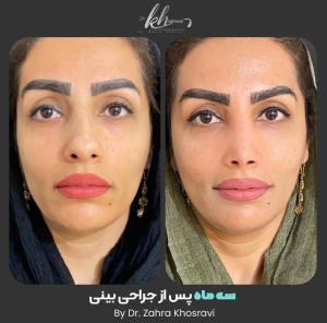 جراحی-بینی-32