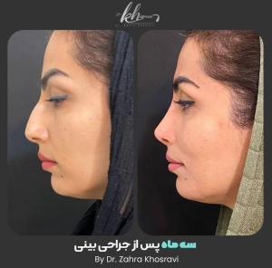 جراحی-بینی-33