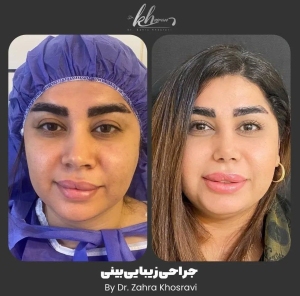 جراحی-بینی-34