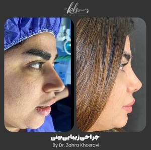 جراحی-بینی-35