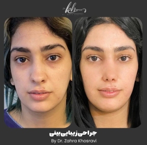 جراحی-بینی-36