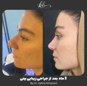 جراحی-بینی-38