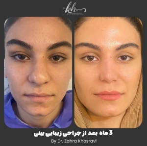 جراحی-بینی-39