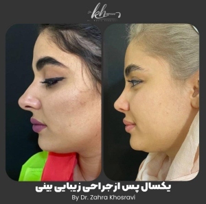 جراحی-بینی-40