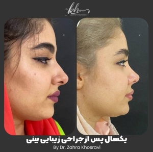 جراحی-بینی-41