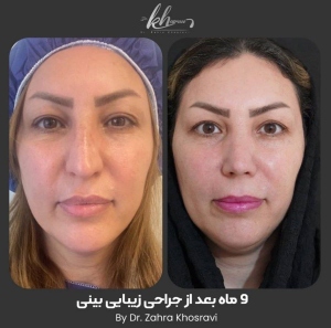 جراحی-بینی-42