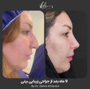 جراحی-بینی-43