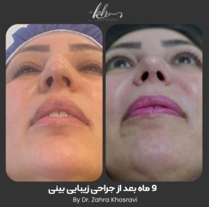 جراحی-بینی-44
