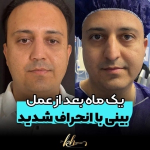 جراحی-بینی-45