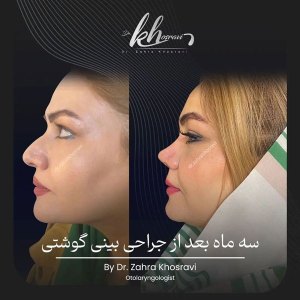 جراحی-بینی-6