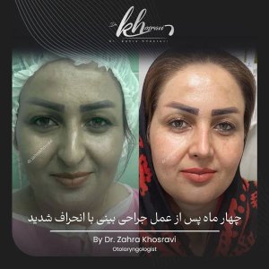 جراحی-بینی-7