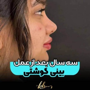rhinoplasty-48