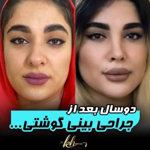rhinoplasty-49