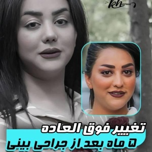 rhinoplasty-50