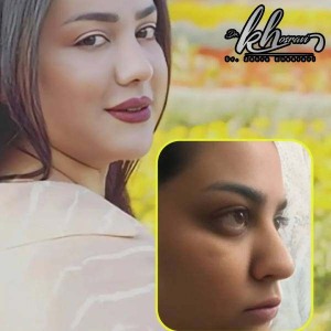 rhinoplasty-51