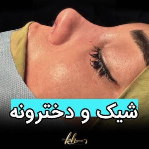rhinoplasty-52