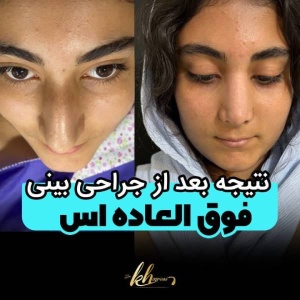 rhinoplasty-54