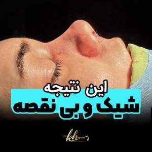 rhinoplasty-56