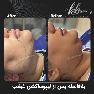 لیپوساکشن-غبغب-1