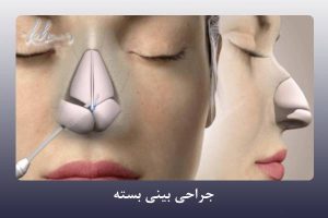 جراحی بینی بسته