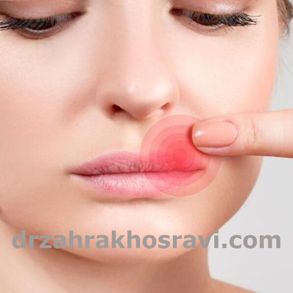 تبخال و عمل بینی - دکتر زهرا خسروی - https://drzahrakhosravi.com/
