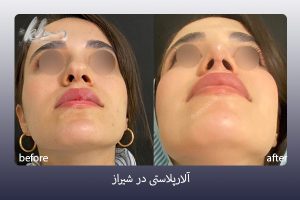 نامتقارن بودن سوراخ‌ های بینی بعد از جراحی - دکتر زهرا خسروی
