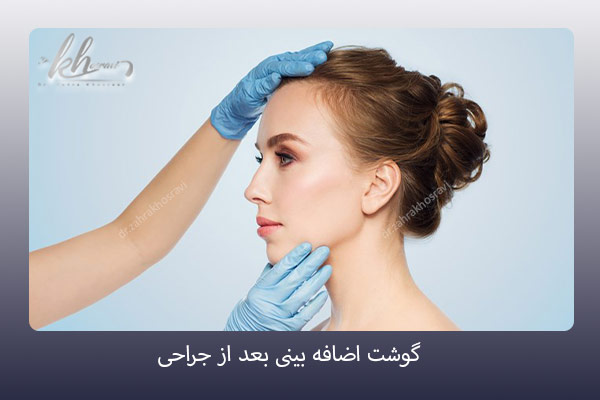 گوشت اضافه بعد از عمل بینی - دکتر زهرا خسروی