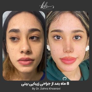 عکس عمل بینی
