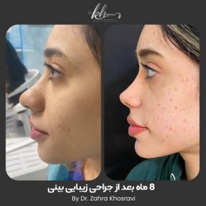 تصویر عمل رینوپلاستی