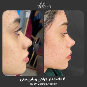 قبل و بعد از جراحی بینی