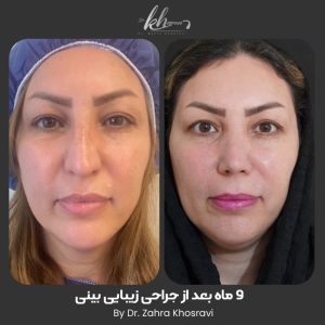 نمونه کار عمل بینی در شیراز