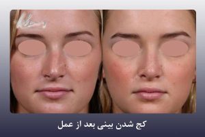 کج شدن بینی بعد از عمل