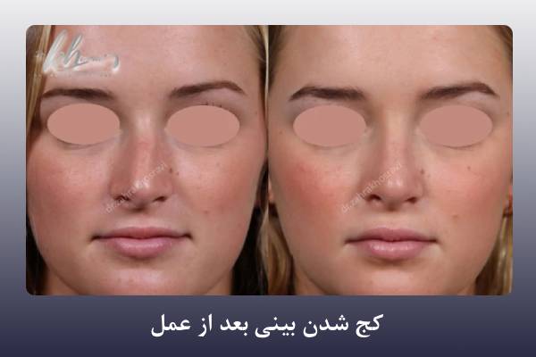 کج شدن بینی بعد از عمل