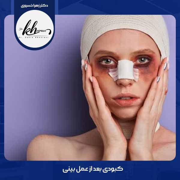 کبودی بعد از عمل بینی